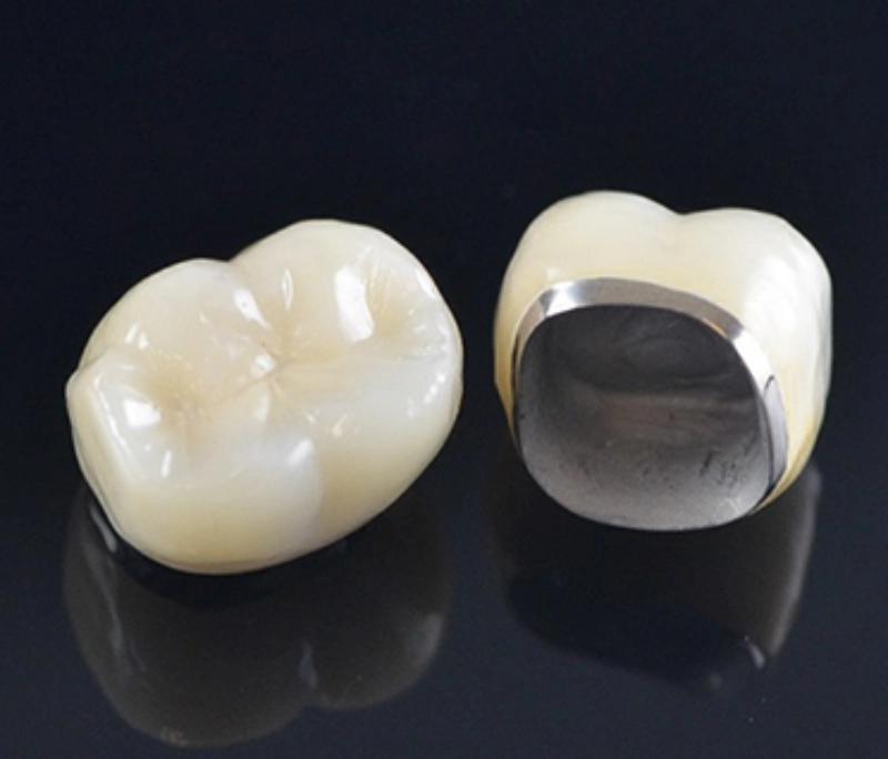 Răng sứ kim loại thường sử dụng hợp kim Ni-Cr hoặc Co-Cr